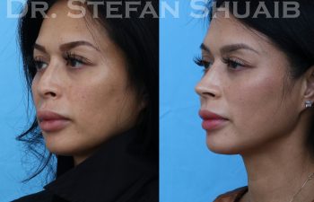 female patient before and after rhinoplasty procedure