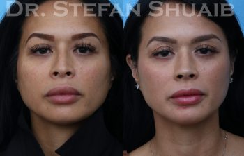 female patient before and after rhinoplasty procedure