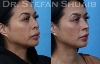 female patient before and after rhinoplasty procedure