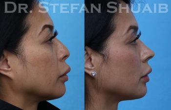 female patient before and after rhinoplasty procedure