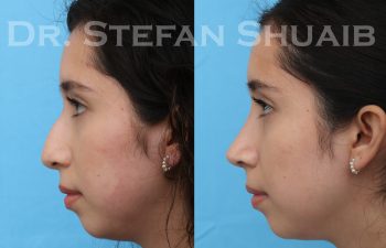 female patient before and after rhinoplasty procedure