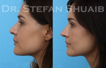 female patient before and after revision rhinoplasty procedure