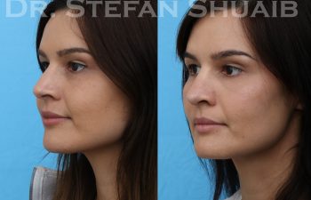 female patient before and after revision rhinoplasty procedure