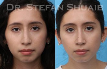 female patient before and after rhinoplasty procedure