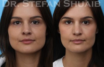 female patient before and after revision rhinoplasty procedure