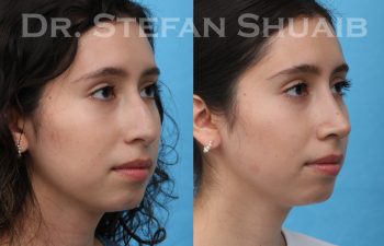 female patient before and after rhinoplasty procedure