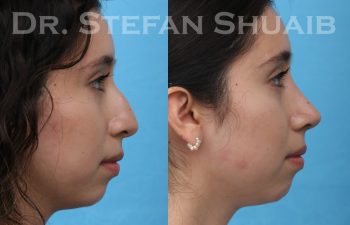 female patient before and after rhinoplasty procedure