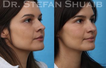 female patient before and after revision rhinoplasty procedure