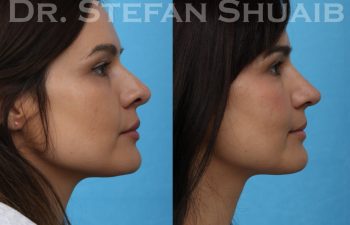 female patient before and after revision rhinoplasty procedure