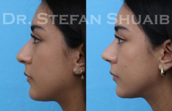 female patient before and after rhinoplasty procedure