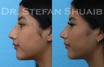 female patient before and after rhinoplasty procedure