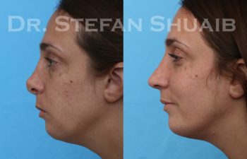 female patient before and after revision rhinoplasty procedure