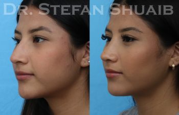 female patient before and after rhinoplasty procedure