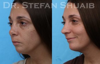 female patient before and after revision rhinoplasty procedure