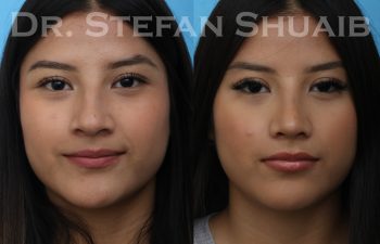 female patient before and after rhinoplasty procedure