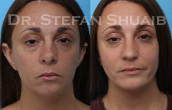 female patient before and after revision rhinoplasty procedure