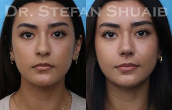 female patient before and after rhinoplasty procedure