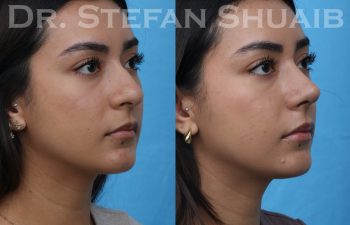 female patient before and after rhinoplasty procedure