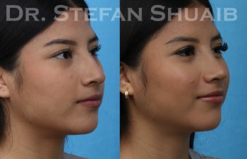 female patient before and after rhinoplasty procedure