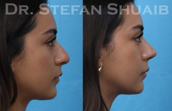 female patient before and after rhinoplasty procedure