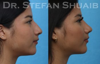 female patient before and after rhinoplasty procedure