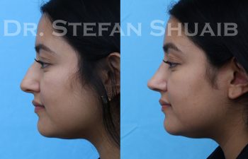 female patient before and after rhinoplasty procedure