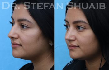 female patient before and after rhinoplasty procedure