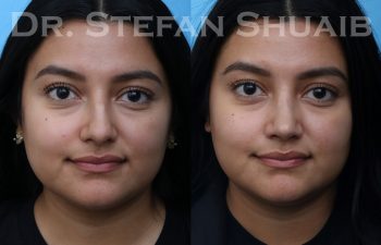 female patient before and after rhinoplasty procedure