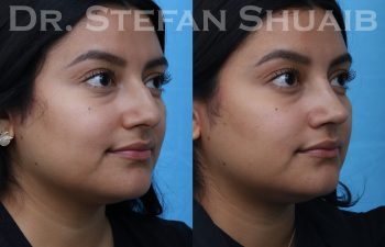 female patient before and after rhinoplasty procedure