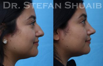 female patient before and after rhinoplasty procedure