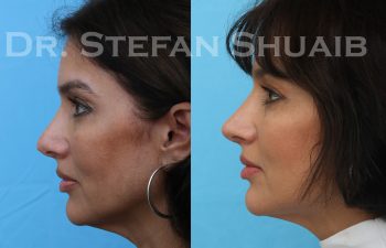 female patient before and after revision rhinoplasty procedure