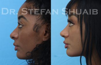 female patient before and after african american rhinoplasty procedure