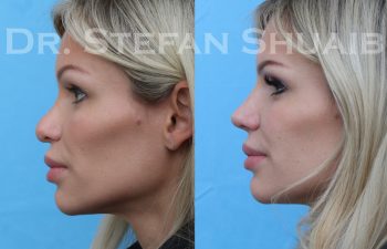 female patient before and after revision rhinoplasty procedure