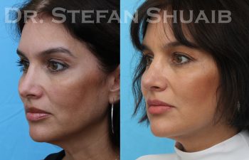 female patient before and after revision rhinoplasty procedure