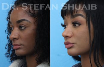 female patient before and after african american rhinoplasty procedure