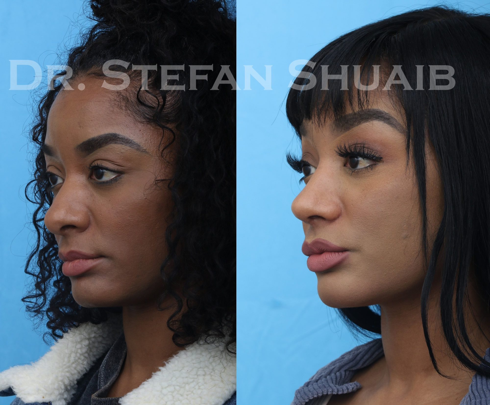female patient before and after african american rhinoplasty procedure