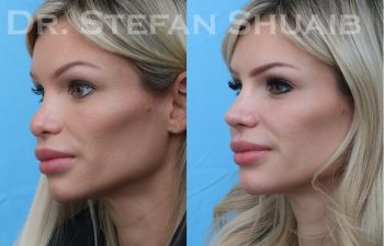 female patient before and after revision rhinoplasty procedure