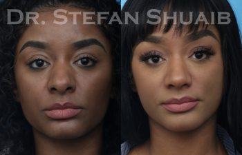 female patient before and after african american rhinoplasty procedure