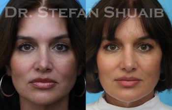 female patient before and after revision rhinoplasty procedure