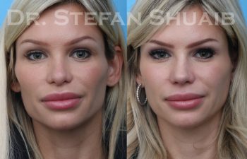 female patient before and after revision rhinoplasty procedure