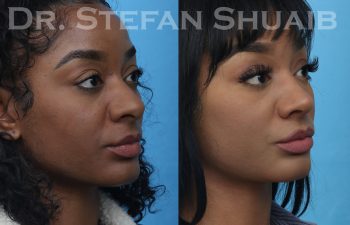 female patient before and after african american rhinoplasty procedure