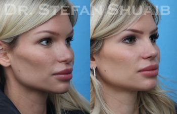 female patient before and after revision rhinoplasty procedure