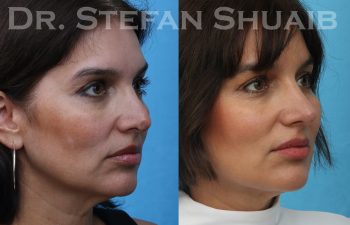 female patient before and after revision rhinoplasty procedure