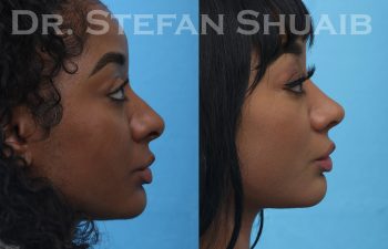 female patient before and after african american rhinoplasty procedure