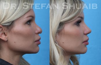 female patient before and after revision rhinoplasty procedure