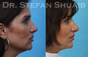 female patient before and after revision rhinoplasty procedure