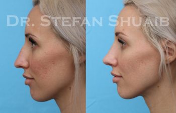 female patient before and after rhinoplasty procedure