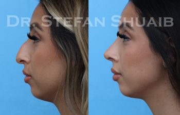 patient before and after rhinoplasty