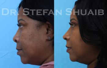 female patient before and after african american rhinoplasty procedure