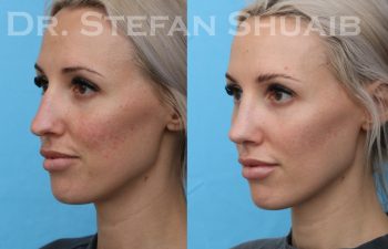 female patient before and after rhinoplasty procedure